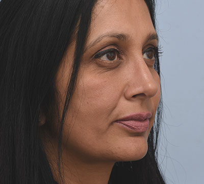 2 years after Rhinoplasty.