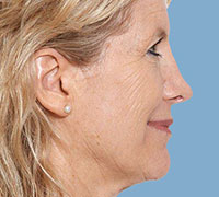 After Rhinoplasty