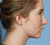 After Rhinoplasty