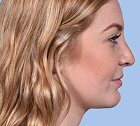 After Rhinoplasty