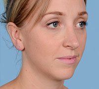 After Rhinoplasty