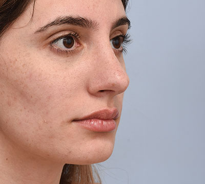 After Rhinoplasty